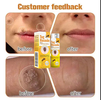 ✅ Official store: 🔥🐝AQA™TagRecede Bee Spray ✨👨‍⚕️ Approved by the American Association of Dermatology (AAOS) (Removal of skin tags, warts, nevus, fibromatous nevus, lipofluid keratosis, filamentous skin tags, fibroepithelial polyps, or stem skin tags)